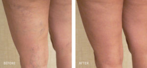 Spider Vein Removal New Haven - Using Injection Sclerotherapy